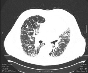 HRCT Scans Used To Evaluate Idiopathic Pulmonary Fibrosis