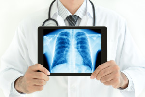 Idiopathic Pulmonary Fibrosis chest X-Ray