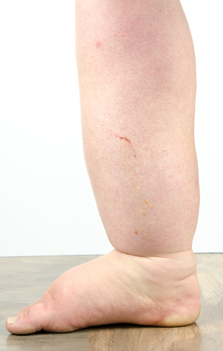 Edema & Leg Swelling