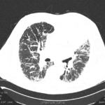 IPF CT Scan | Expiration-Supine