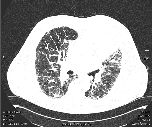 IPF CT Scan | Expiration-Supine