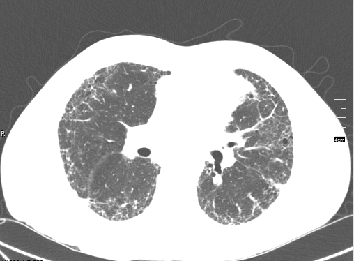 HRCT showing fibrosis